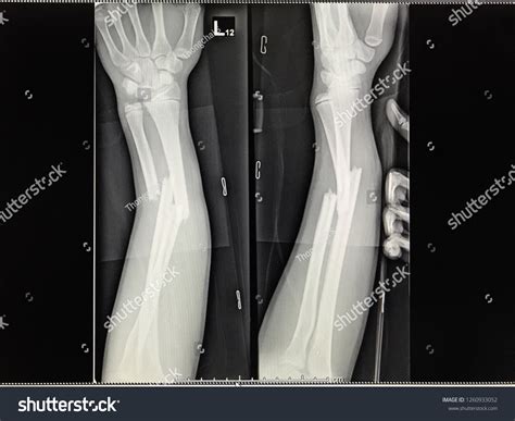 Broken Arm X Ray Before And After at Dennis Raleigh blog