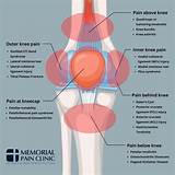 Knee Pain Location Chart | Memorial Pain Clinic | Tulsa, OK