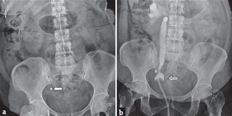 Image result for Retro Pyelogram Cystoscopy