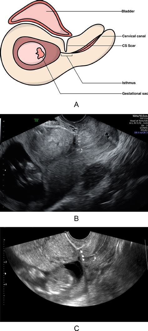 First-trimester screening for placenta accreta spectrum - American Journal of Obstetrics ...