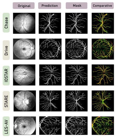 Segmentation of Retinal Blood Vessels Using Focal Attention Convolution ...
