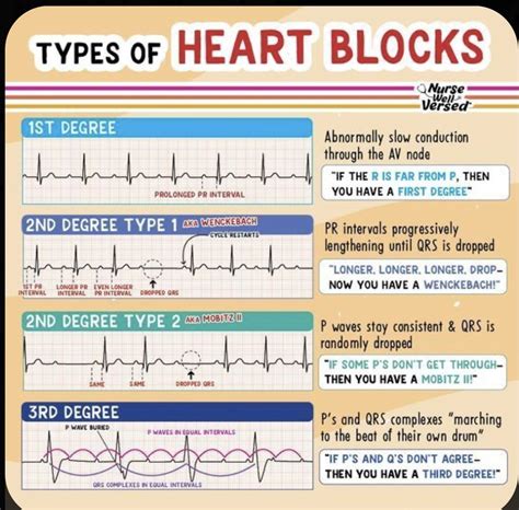 Basic ECG Rhythms 的图像结果