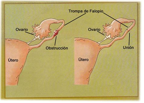 Tratamientos para la infertilidad y embarazos: - Obstrucción de Trompas ...