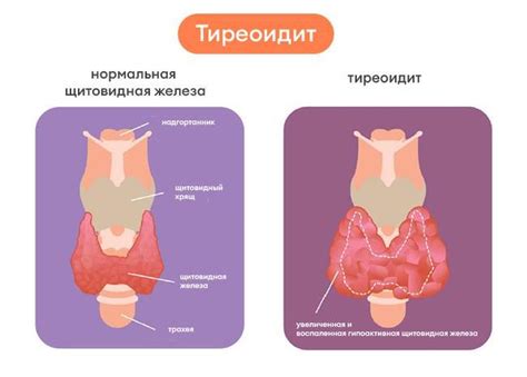 Тиреоидит: описание, симптомы, диагностика и лечение | ЛабСтори