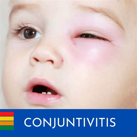 Conjuntivitis