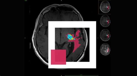 Image result for Brain Tumor Segmentation with Python Code