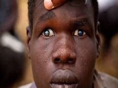Researchers discover new diagnostic method for posterior uveitis eye ...