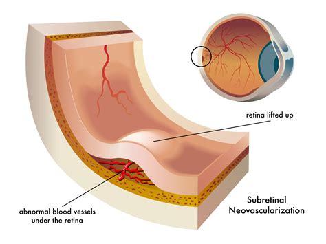 Wet Macular Degeneration: Symptoms, Treatment, and Research Updates