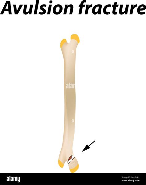 Avulsion Fracture Quizlet at Linda Redmon blog