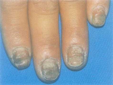 灰指甲图片初期症状，怎么确定是不是灰指甲-百度经验