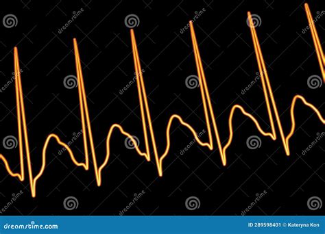 Image result for Atrial Flutter Synchronized Cardioversion