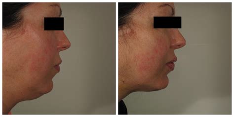 Laser Lipo Pads Before And After at Terry Greene blog