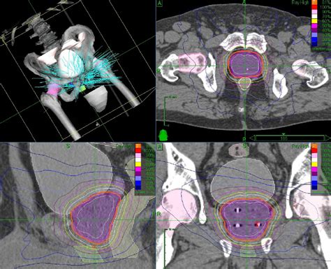 Prostate Radiation Simulation 的图像结果
