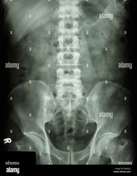 What Does Lumbosacral X Ray Show at Aiden Ann blog
