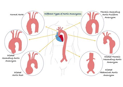 Aorta and aortic dissections – myheart