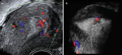 Ultrasound Evaluation of Endometrium | Obgyn Key
