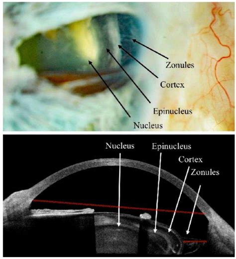 Multimodal Imaging of the Bimatoprost Sustained Release Implant ...