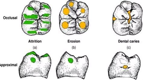 ATTRITION OF TEETH (Regressive Alterations of Teeth) | PPTX
