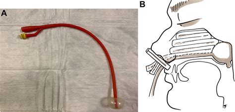 Managing Epistaxis - Annals of Emergency Medicine