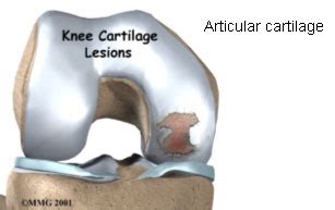 ADVANCE ORTHOPEDIC AND SPORTS INJURY HOSPITAL || Cartilage Injuries by ...