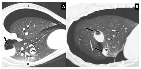Trauma-Associated Pulmonary Laceration in Dogs—A Cross Sectional Study ...
