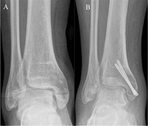 Isolated Medial Malleolus Fractures: Conventional Techniques Versus ...