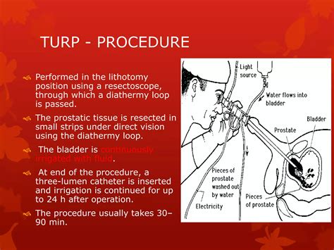 Anaesthetic managent of turp | PPTX