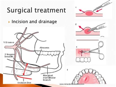 Carbuncle Drainage Procedure 的图像结果
