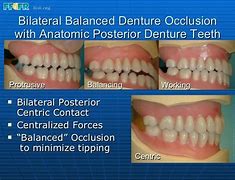 Image result for 侧方 lateral balanced occlusion