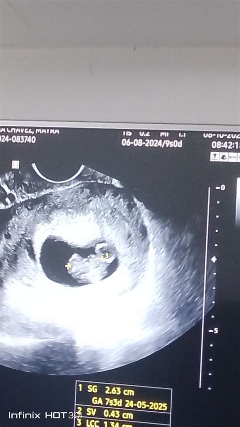 Ecografía de 8 semanas | BabyCenter