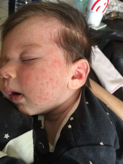 Heat Rash On Face Baby