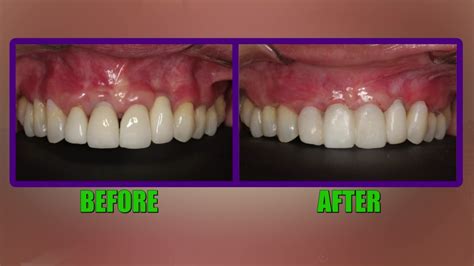 Gums Receding From Front Teeth at Garry Beckwith blog