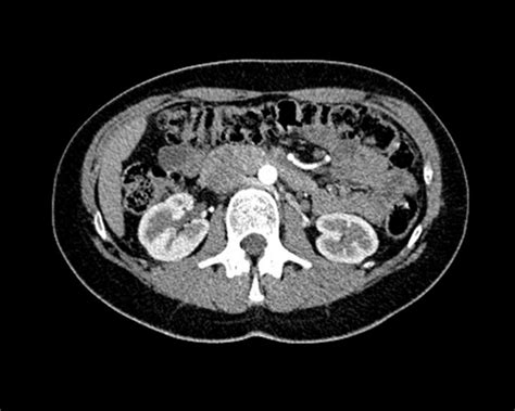 Image result for CT Cystogram vs Urogram