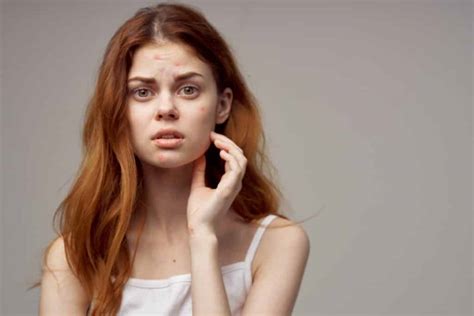 How PCOD Affects Your Skin: What You Can Do About It!