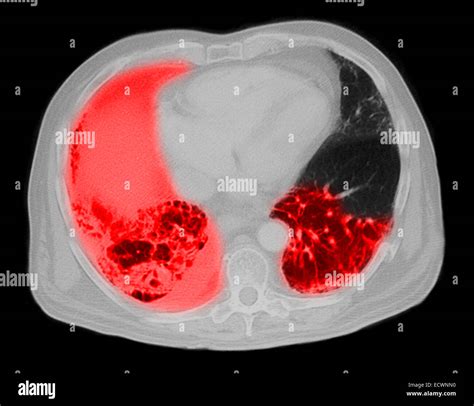 Pneumonia Ct Scan