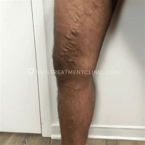 Can Varicose Veins Go Away on Their Own? | What to Expect | Vein Treatment Clinic