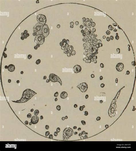 Caudate Transitional Epithelial Cells In Urine Sediment FUS Series Of
