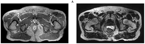 Rectal Spacer Placement for Anorectal Reirradiation of De Novo Rectal ...