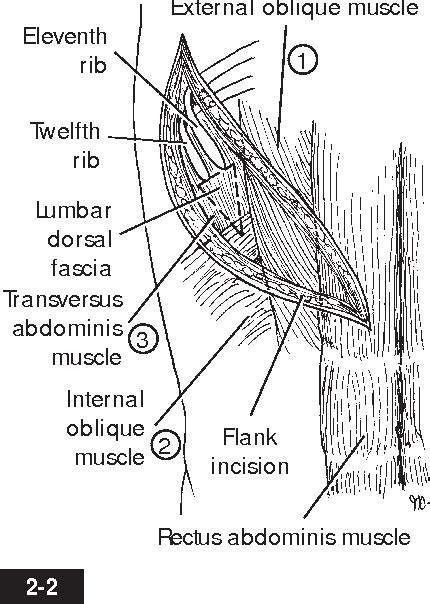 Image result for Flank Incision Nephrectomy