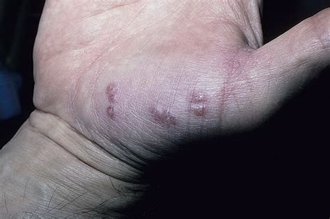Herpes on Hands Pictures – 48 Photos & Images / illnessee.com