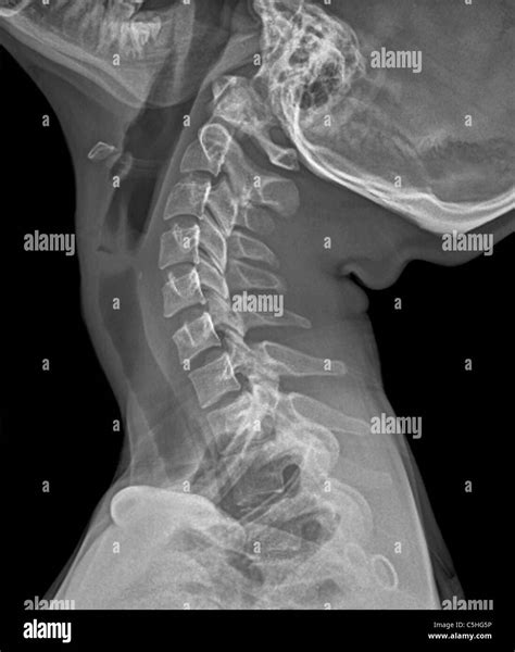 Normal Neck X Ray High Resolution Stock Photography and Images - Alamy - neck x ray