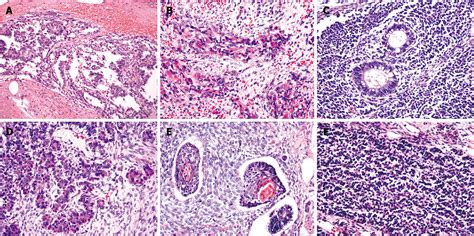 Yolk Sac Tumor Schiller Duval Bodies