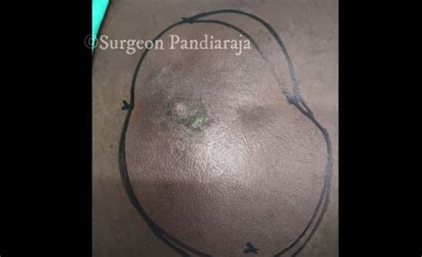 Image result for Removing Carbuncle