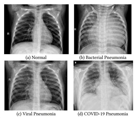 Chest X Ray Images Of Bronchitis at Mitchell Cushing blog