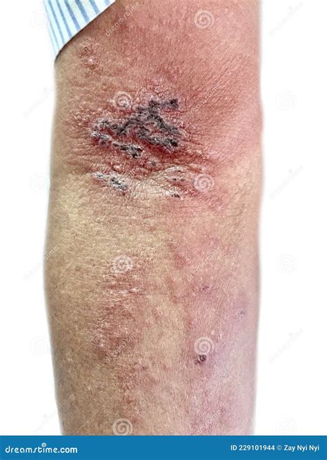 Herpes On Leg