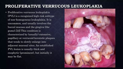 Leukoplakia | PPTX