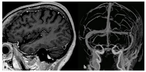 Imaging of Cerebral Venous Thrombosis