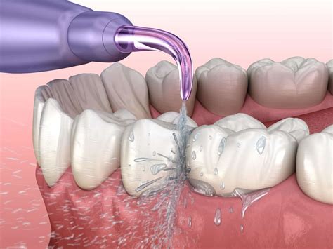 Waterpik vs. Flossing: Which Is Better for Your Teeth?