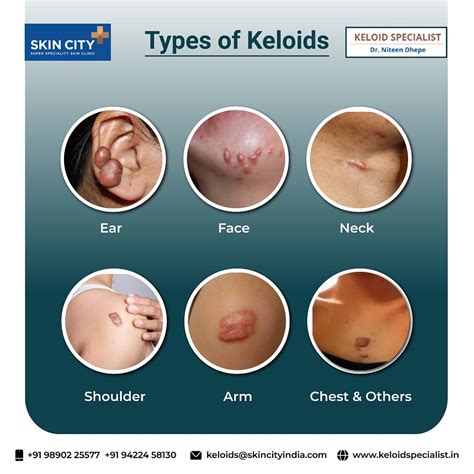 Types of Keloid — Ear, Face, Neck, Shoulder, Arm and Chest - Keloidspecialist - Medium
