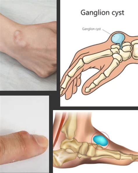Ganglion Cysts and Physiotherapy